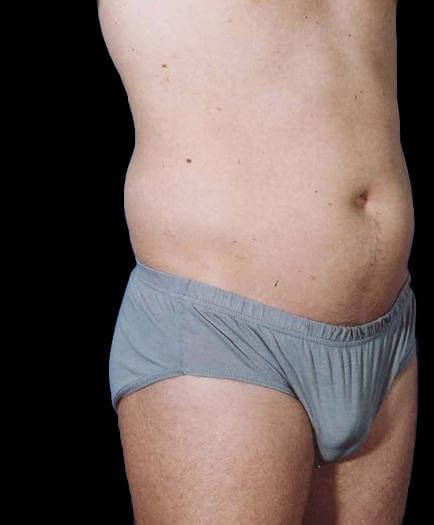 Male Liposuction Before