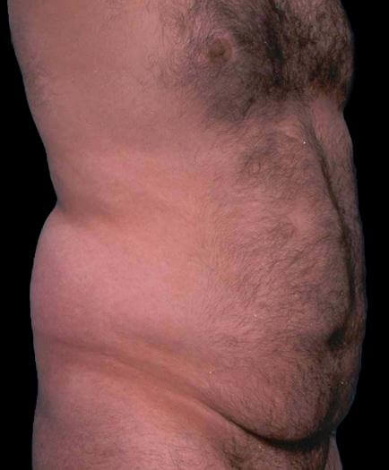 Liposuction For Men Before