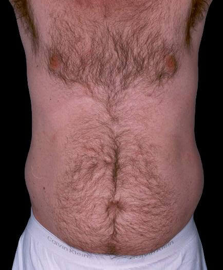 Abdominal Liposuction Before