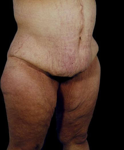 Post Bariatric Surgery Before
