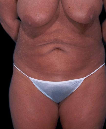 Tummy Tuck With Breast Reduction Before