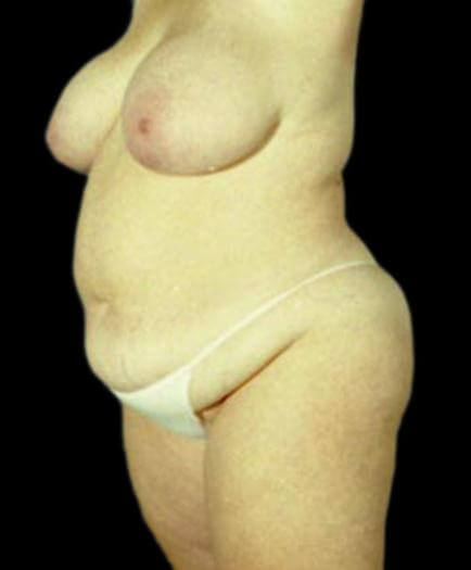 Body Contouring & Breast Reduction Before