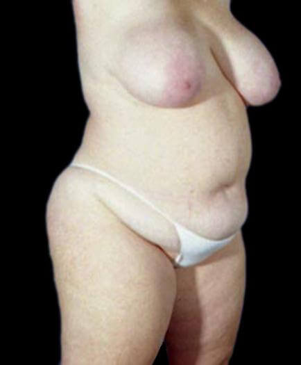 Body Contouring & Breast Reduction Quarter View Before 