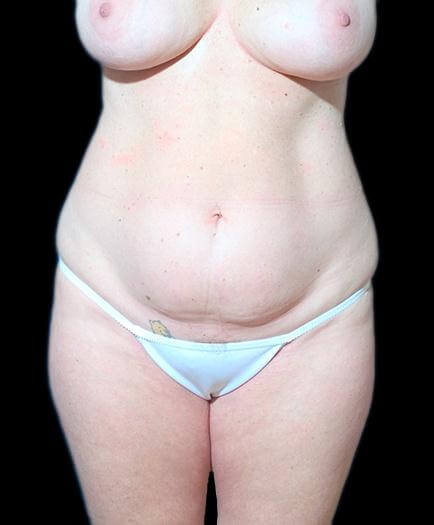 Breast Augmentation & Abdominoplasty Before