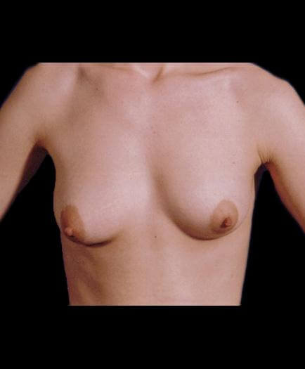 Breast Enlargement & Nipple Surgery Before