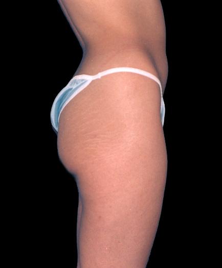 Buttock Augmentation Side View Before	