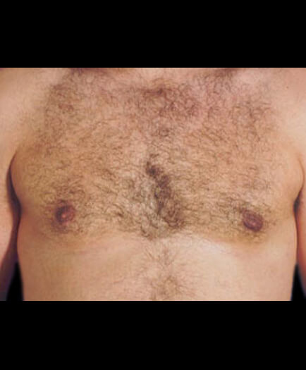 Male Breast Reduction After