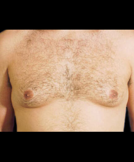 Male Breast Reduction Before