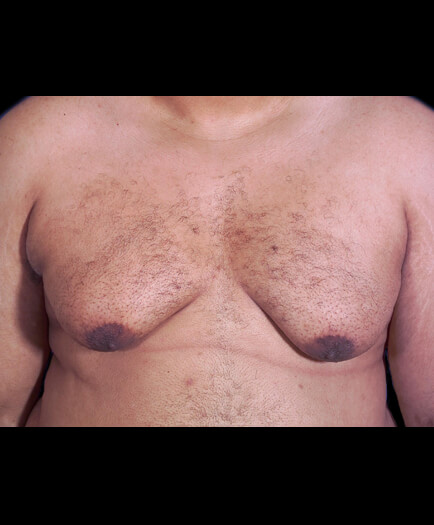 Gynecomastia Surgery Before