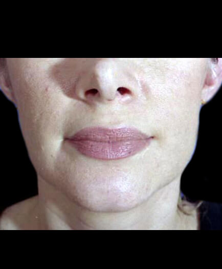 After Lip Augmentation