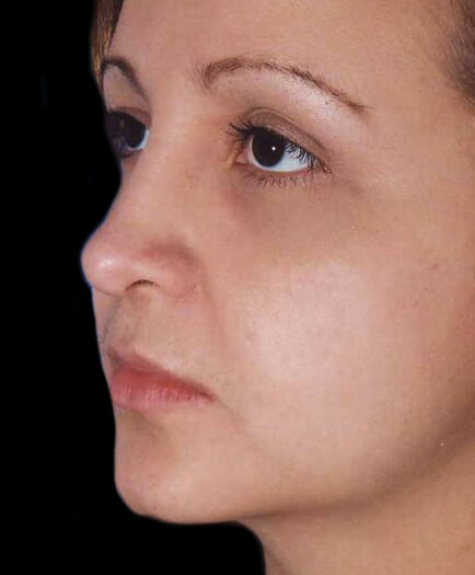 After Rhinoplasty