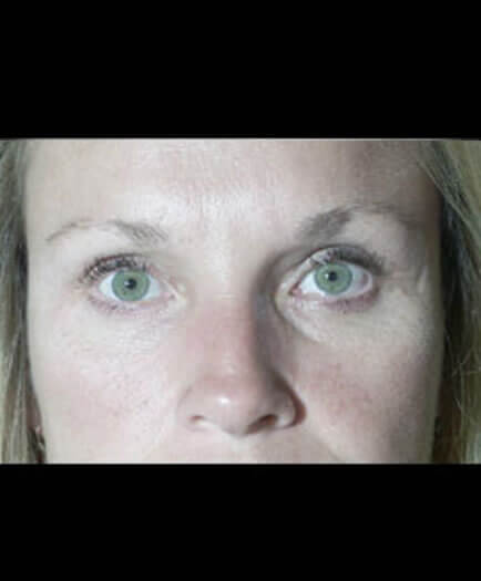 After Blepharoplasty