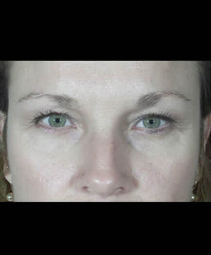 Before Cosmetic Injectables