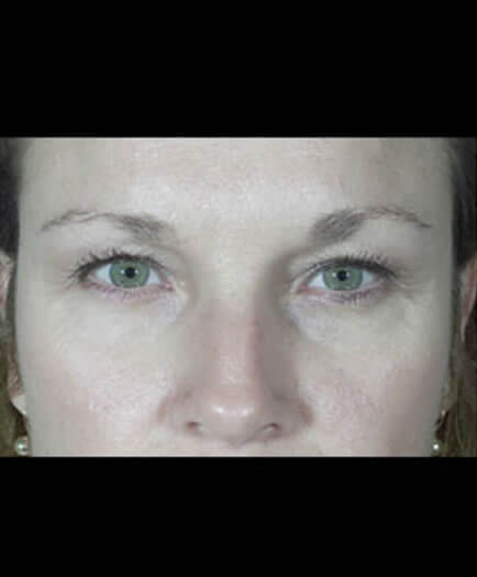 Before Blepharoplasty