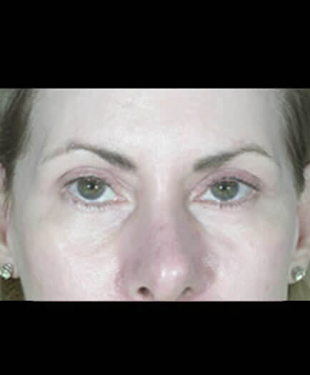 Blepharoplasty After