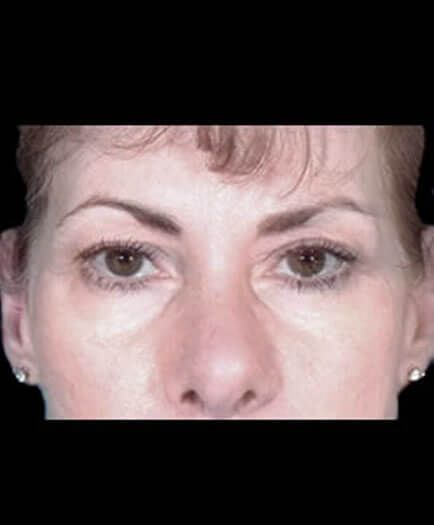 Blepharoplasty Before