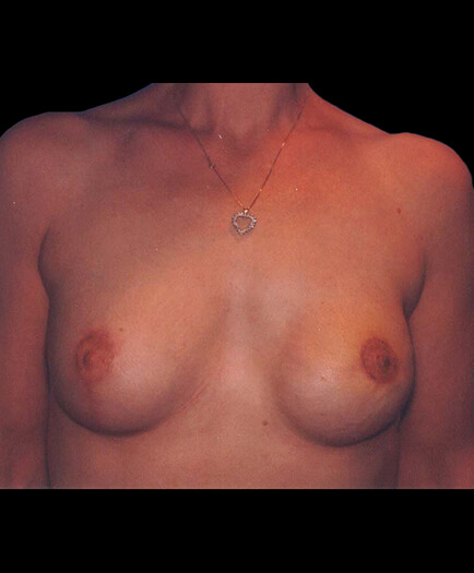 After Breast Reconstruction