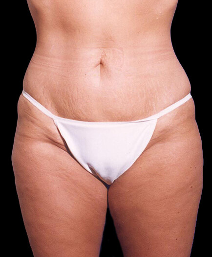 Liposuction After