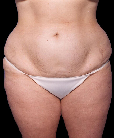 Liposuction Before