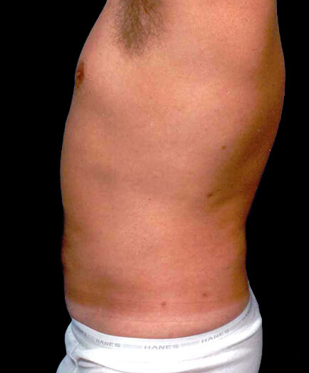 Male Lipo After