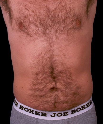 Male Liposuction After