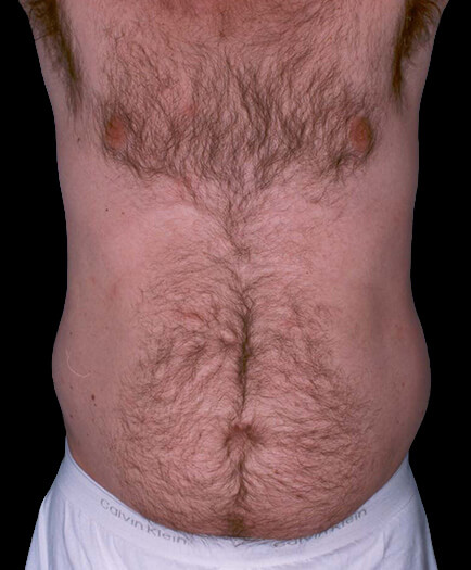 Male Liposuction Before