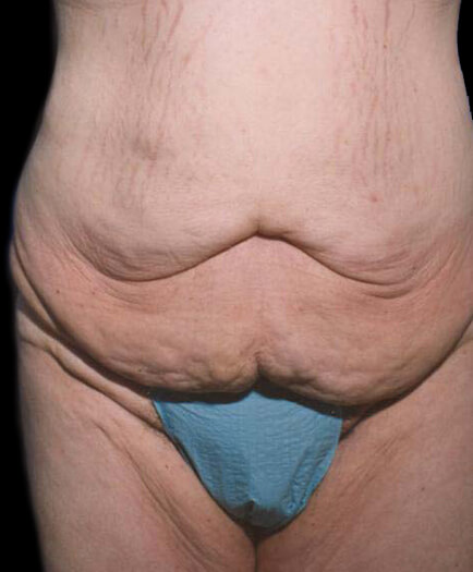 Tummy Tuck For Men Before