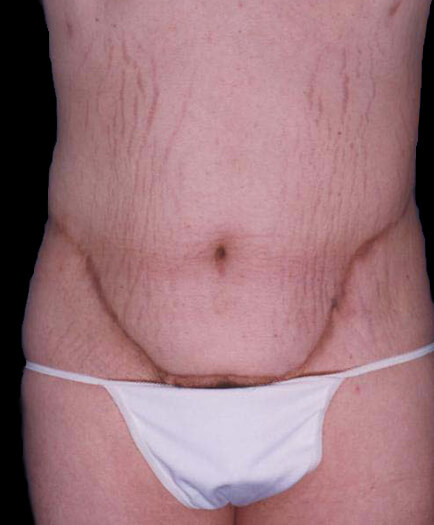 Are You Worried About Tummy Tuck Scars? Here's How Dr. Vinyard Prevents  Them!