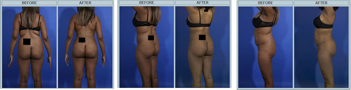 Brazilizn butt lift before and after