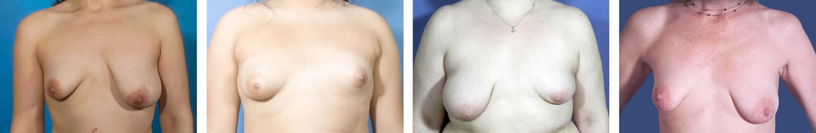 Tuberous breast deformity examples