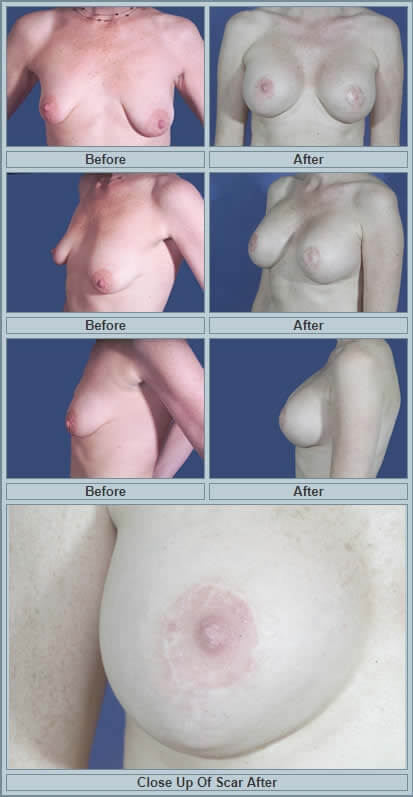 Tuberous breast deformity surgery before and after