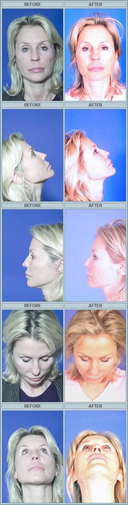 Sculptra before and after