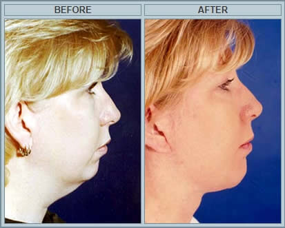 Neck lift before and after