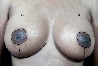 Short scar breast lift incision diagram